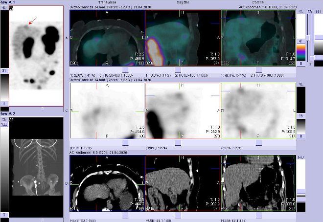 Obr. . 7: Fze SPECT/CT bicha a pnve 24 hod. po aplikaci OctreoScanu. Zameno na suspektn loisko vpravm laloku jaternm ventrokraniln.