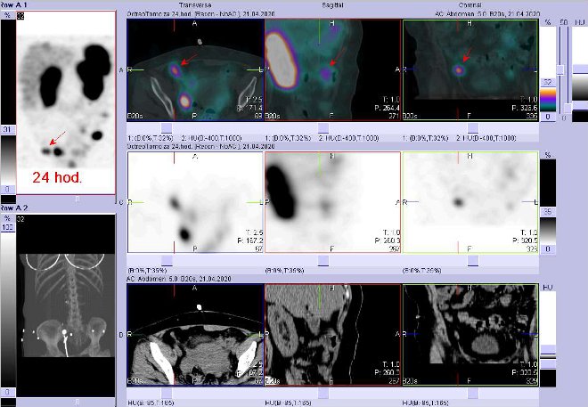 Obr. . 8: Fze SPECT/CT bicha a pnve 24 hod. po aplikaci OctreoScanu. Zameno na loisko v pnvi vpravo ventrln.