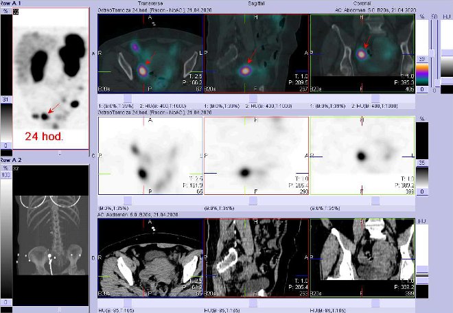 Obr. . 9: Fze SPECT/CT bicha a pnve 24 hod. po aplikaci OctreoScanu. Zameno na loisko v pnvi vpravo.