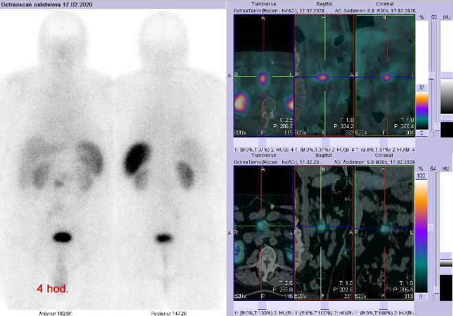 Obr. . 4: Celotlov scintigrafie a fze SPECT/CT bicha 4 hod. po aplikaci OctreoScanu. Zameno na loisko na radixu mezenteria vblzkosti mezenterilnho cvnho svazku.