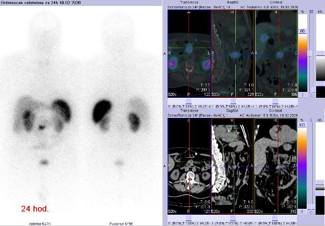 Obr. . 7: Celotlov scintigrafie a fze SPECT/CT bicha 24 hod. po aplikaci OctreoScanu. Zameno na loisko na radixu mezenteria vblzkosti mezenterilnho cvnho svazku.