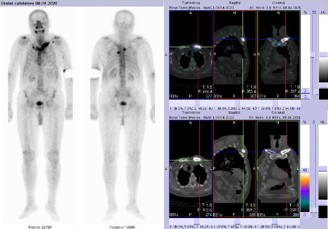 Obr.1: Celotlov scintigrafie vpedn a zadn projekci a fze obraz SPECT/CT a samostatn CT.  Vpravo zameno na loisko vlev kln kosti. ezy transverzln,  sagitln a koronln.