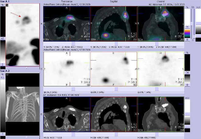 Obr. . 13: Fze SPECT/CT hrudnku 24 hod. po aplikaci OctreoScanu. Zameno na loisko v lev kln kosti a jejm okol.