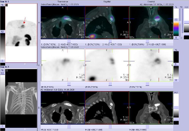 Obr. . 8: Fze SPECT/CT hrudnku 4 hod. po aplikaci OctreoScanu. Zameno na loisko v lev kln kosti a jejm okol.