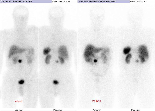 Obr.1: Celotlov scintigrafie v pedn a zadn projekci. Vyeten 4 hod. (vlevo) a 24 hod. (vpravo) po aplikaci radioindiktoru.