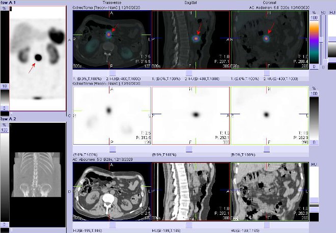 Obr..2: Fze obraz SPECT a CT  vyeten bicha a pnve 4 hod. po aplikaci radiofarmaka. Zameno na loisko v bie pod hlavou pankreatu v rovni seku D3 duodena velikosti 23x14 mm.