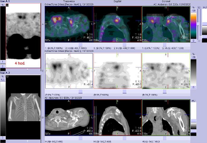 Obr.3: Fze obraz SPECT a CT  vyeten hrudnku 4 hod. po aplikaci radiofarmaka. Zameno na laterln st lev kln kosti.