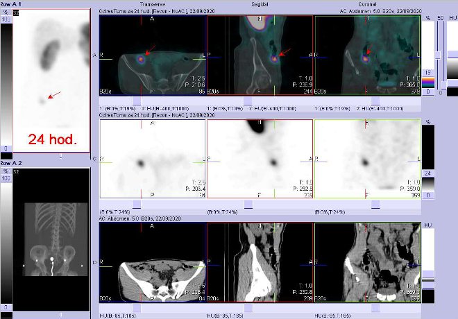 Obr. . 2: Fze obraz SPECT a CT  vyeten bicha a pnve 24 hod. po aplikaci radiofarmaka. Zameno na loisko v bie v cku.
