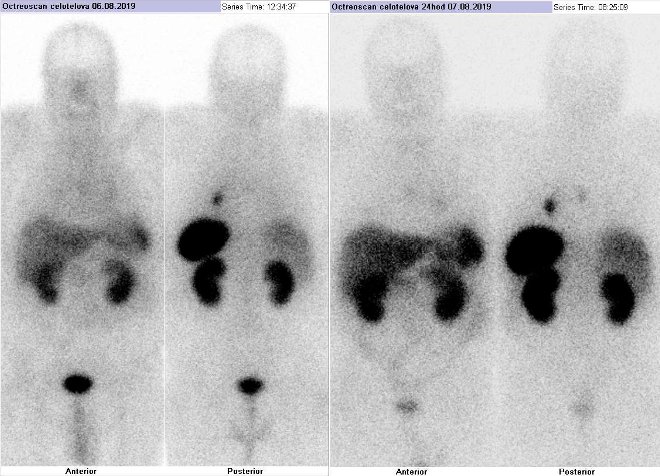 Obr.1: Celotlov scintigrafie vpedn a zadn projekci. Vyeten 4 hod. (vlevo) a 24 hod. (vpravo) po aplikaci radioindiktoru.