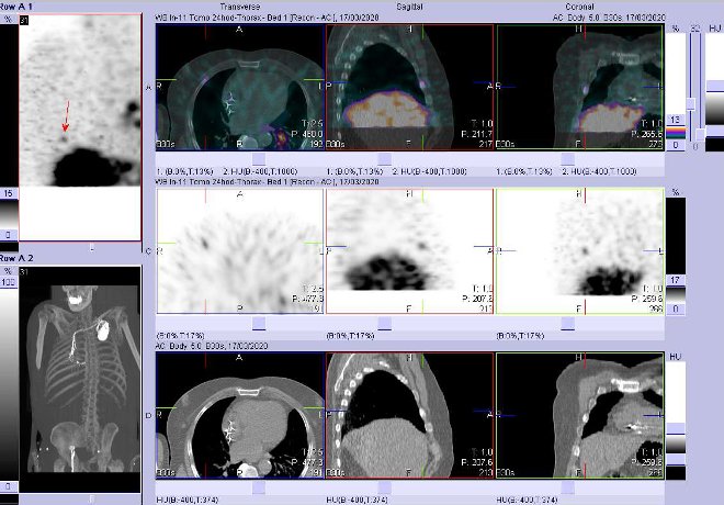 Obr. . 10: Fze obraz SPECT a CT  vyeten 24 hod. po aplikaci radiofarmaka. Zameno na loisko ve ventrln sti jednoho ebra vpravo.
