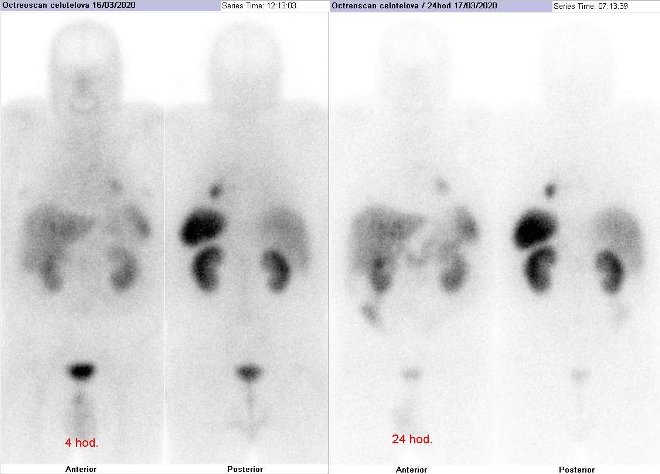 Obr.3: Celotlov scintigrafie vpedn a zadn projekci. Vyeten 4 hod. (vlevo) a 24 hod. (vpravo) po aplikaci radioindiktoru.