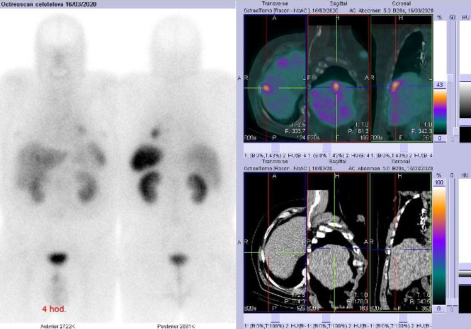 Obr. . 4: Celotlov scintigrafie a fze obraz SPECT a CT  vyeten 4 hod. po aplikaci radiofarmaka. Zameno na loisko v pravm jaternm laloku.