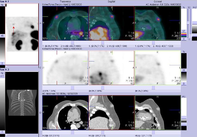 Obr. . 7: Fze obraz SPECT a CT  vyeten 4 hod. po aplikaci radiofarmaka. Zameno na loisko zejm v prsn lze vpravo.