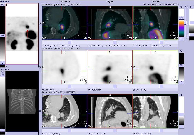 Obr. . 8: Fze obraz SPECT a CT  vyeten 4 hod. po aplikaci radiofarmaka. Zameno na loisko v lev plci.