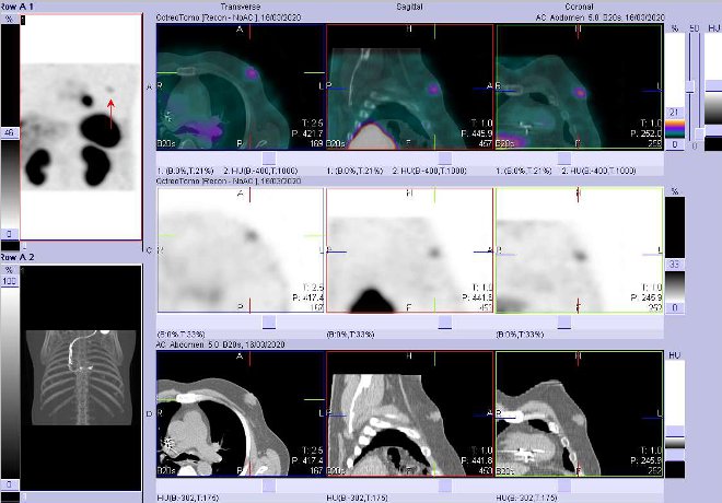 Obr. . 9: Fze obraz SPECT a CT  vyeten 4 hod. po aplikaci radiofarmaka. Zameno na loisko zejm v prsn lze vlevo.