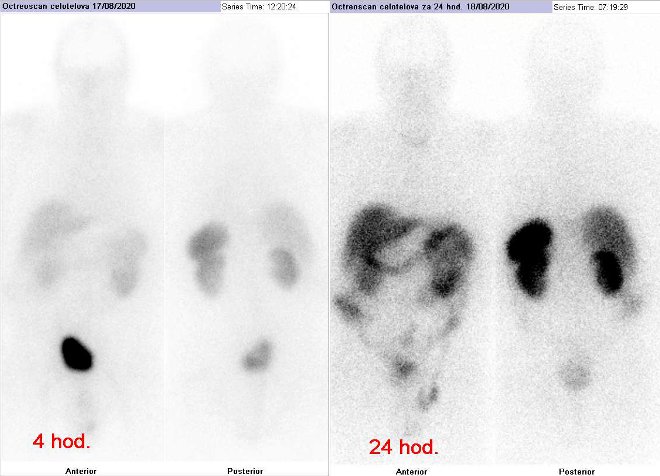 Obr..1: Celotlov scintigrafie v pedn a zadn projekci. Vyeten 4 hod. (vlevo) a 24 hod. (vpravo) po aplikaci radioindiktoru.