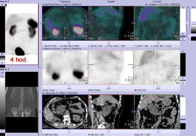 Obr. . 2: Fze obraz SPECT a CT  vyeten 4 hod. po aplikaci radiofarmaka. Zameno na neakumulujc loisko pod hlavou pankreatu.