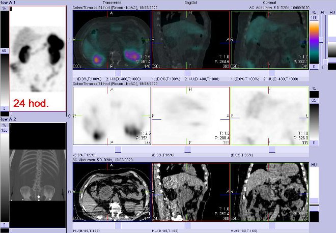 Obr. . 3:Fze obraz SPECT a CT  vyeten 24 hod. po aplikaci radiofarmaka. Zameno na neakumulujc loisko pod hlavou pankreatu.