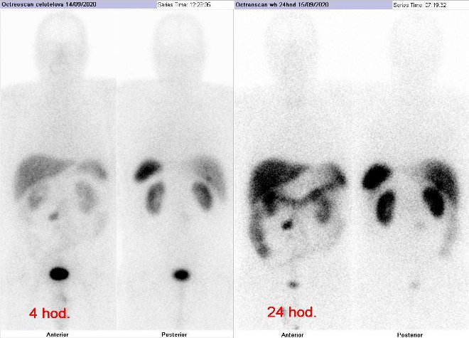 Obr..1: Celotlov scintigrafie v pedn a zadn projekci. Vyeten 4 hod. (vlevo) a 24 hod. (vpravo) po aplikaci radioindiktoru.