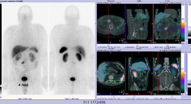 Obr. . 2: Celotlov scintigrafie a fze obraz SPECT a CT  vyeten 4 hod. po aplikaci radiofarmaka. Zameno na loisko v mezogastriu vpravo od stedn ry a na loisko vpravm jaternm laloku dorzln.