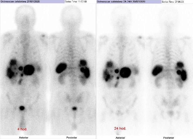 Obr. . 1: Celotlov scintigrafie v pedn a zadn projekci. Vyeten 4 hod. (vlevo) a 24 hod. (vpravo) po aplikaci radioindiktoru.