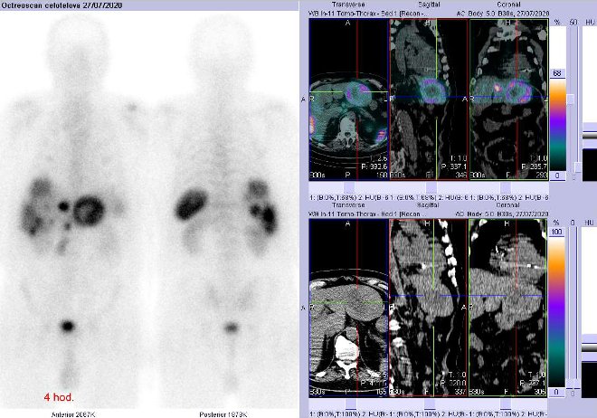 Obr. . 2: Celotlov scintigrafie a fze obraz SPECT a CT  vyeten 4 hod. po aplikaci radiofarmaka. Zameno na velk loisko vlevm jaternm laloku.