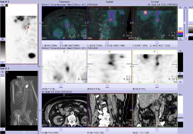 Obr. . 6: Fze obraz SPECT a CT  vyeten 4 hod. po aplikaci radiofarmaka. Zameno na uzlinu periportln.