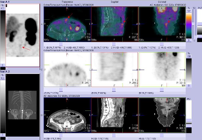Obr..2: Fze obraz SPECT a CT  vyeten 4 hod. po aplikaci radiofarmaka. Zameno na loisko vpodko bicha vrovni pupku.