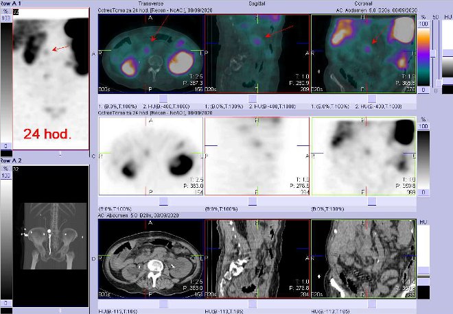 Obr.3: Fze obraz SPECT a CT  vyeten 24 hod. po aplikaci radiofarmaka. Zameno na loisko v oblasti hlavy pankreatu.