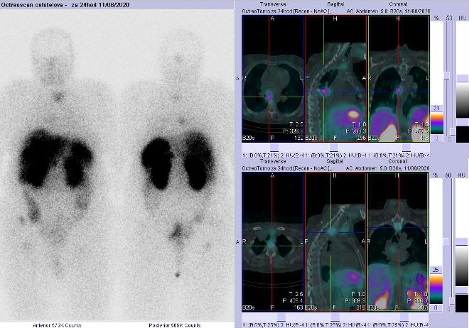 Obr. . 7: Celotlov scintigrafie a fze SPECT/CT krku, hrudnku a proximln sti bicha 24 hod. po aplikaci OctreoScanu. Zameno na loisko vmediastinu vpravo a vobratli Th1.