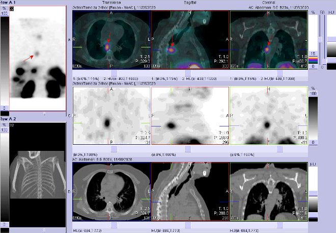 Obr. . 9: Fze SPECT/CT krku, hrudnku a proximln sti bicha 24 hod. po aplikaci OctreoScanu. Zameno na loisko v mediastinu vpravo.