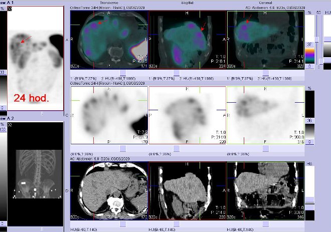 Obr. . 5: Fze obraz SPECT a CT  vyeten bicha a sti pnve 24 hod. po aplikaci radiofarmaka. Zameno na loisko vpravm jaternm laloku.