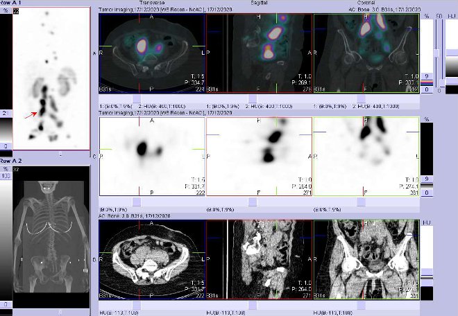 Obr. . 14: Fze SPECT/CT 24 hod. po aplikaci OctreoScanu. Zameno na loisko v uzlin vpravo parailicky.