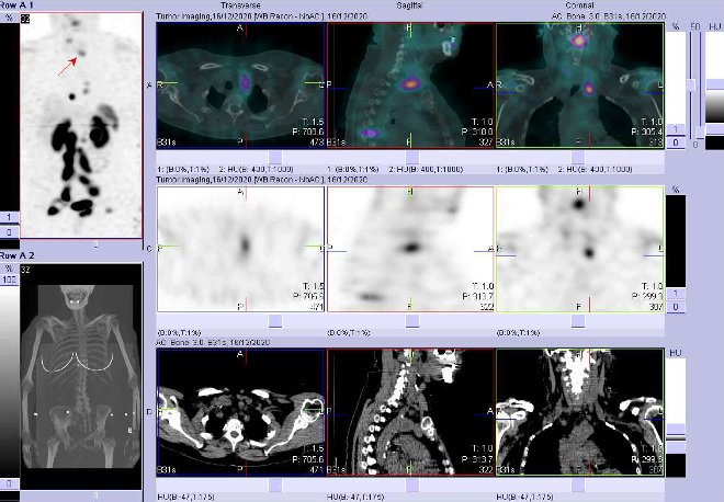 Obr.3: Fze SPECT/CT 4 hod. po aplikaci OctreoScanu. Zameno na loisko v krn uzlin vlevo.