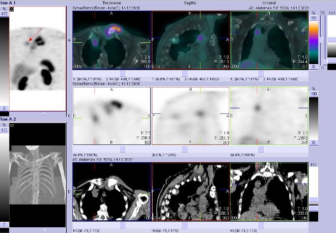 Obr. . 3: Fze SPECT/CT hrudnku 4 hod. po aplikaci OctreoScanu. Zameno na loisko ve ventrokraniln sti prav plce.