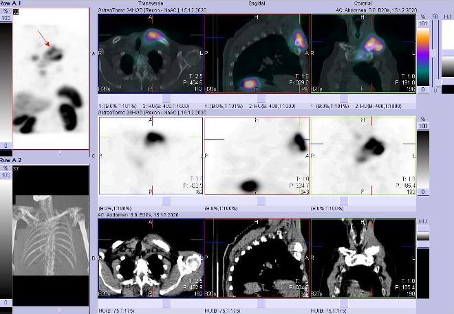 Obr. . 8: Fze SPECT/CT hrudnku 24 hod. po aplikaci OctreoScanu. Zameno na loisko v lev kln kosti a jejm okol.