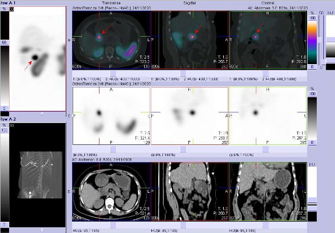 Obr. . 4: Fze SPECT/CT bicha a pnve 4 hod. po aplikaci OctreoScanu. Zameno na loisko v uzlin pi hlav pankreatu.
