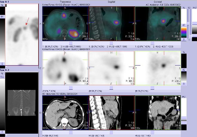 Obr. . 3: Fze obraz SPECT a CT  vyeten 4 hod. po aplikaci radiofarmaka. Zameno na loisko v levm jaternm laloku.