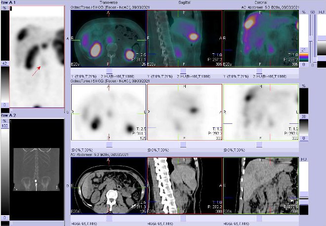 Obr. . 5: Fze obraz SPECT a CT  vyeten 4 hod. po aplikaci radiofarmaka. Zameno na loisko vbie aortokavln vrovni L2-L3.