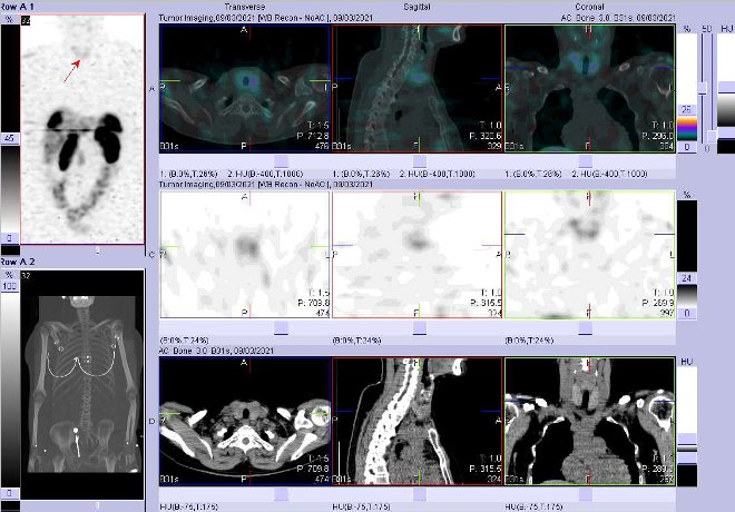 Obr. . 6: Fze obraz SPECT a CT  vyeten 24 hod. po aplikaci radiofarmaka. Mrn akumulace radioindiktoru v lalocch ttn lzy.