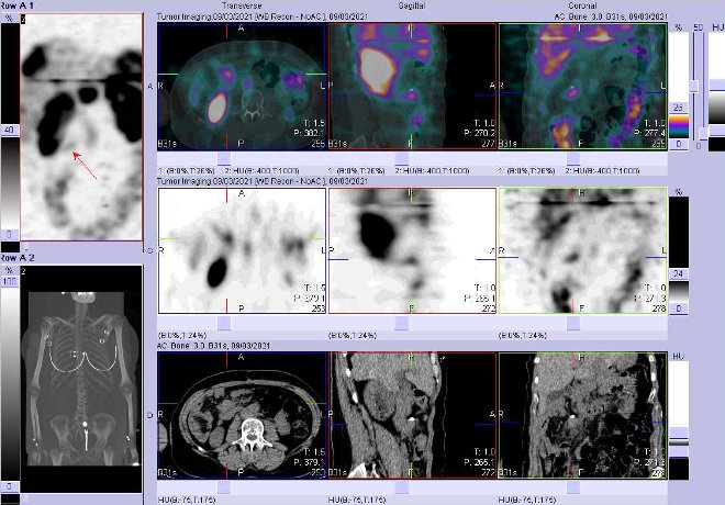 Obr. . 7: Fze obraz SPECT a CT  vyeten 24 hod. po aplikaci radiofarmaka. Zameno na loisko mesenteriln vpravm mezogastriu.