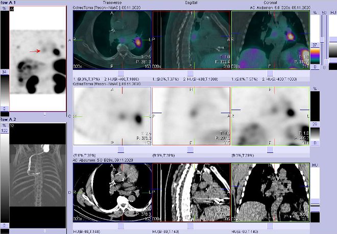 Obr. . 6: Fze obraz SPECT a CT  vyeten 4 hod. po aplikaci radiofarmaka. Zameno na uzlinu pod bifurkac trachey.