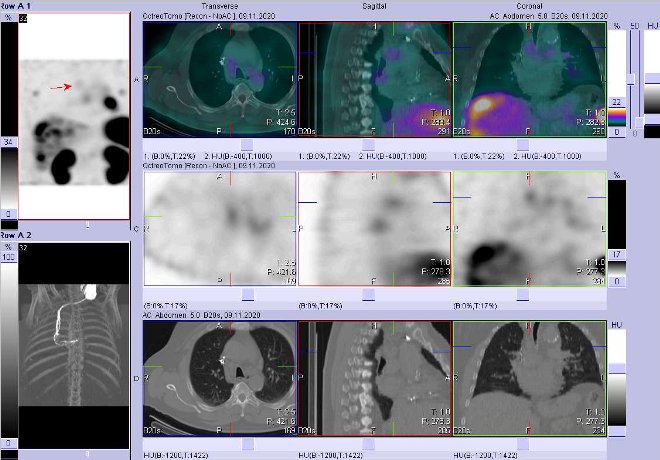 Obr. . 7: Fze obraz SPECT a CT  vyeten 4 hod. po aplikaci radiofarmaka. Zameno na uzlinu v mediastinu paratracheln vpravo.