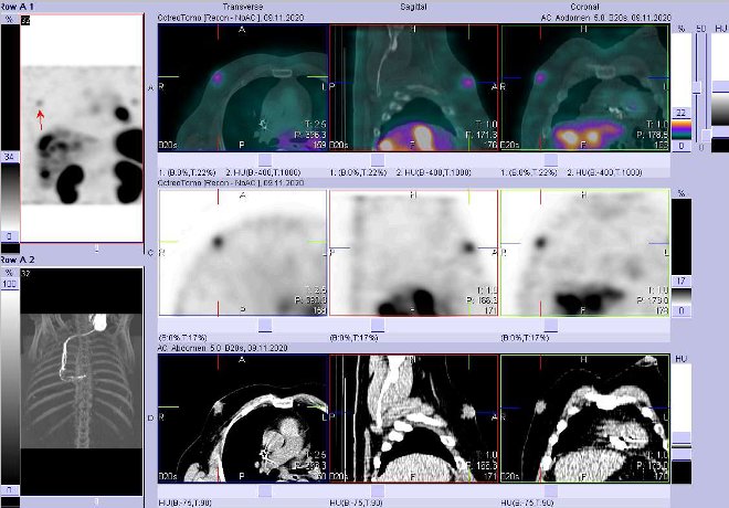 Obr. . 8: Fze obraz SPECT a CT  vyeten 4 hod. po aplikaci radiofarmaka. Zameno na loisko v pravm prsu.