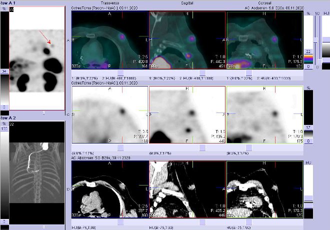 Obr. . 9: Fze obraz SPECT a CT  vyeten 4 hod. po aplikaci radiofarmaka. Zameno na loisko vlevm prsu.