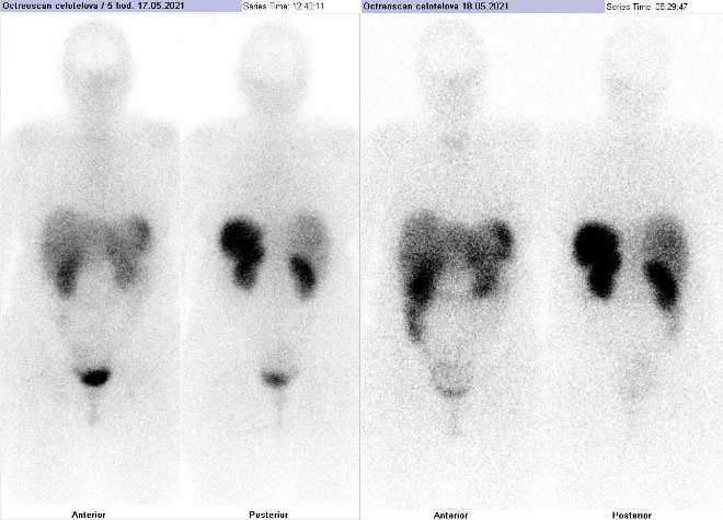 Obr. . 1: Celotlov scintigrafie vpedn a zadn projekci. Vyeten 5 hod. (vlevo) a 24 hod. (vpravo) po aplikaci radioindiktoru.