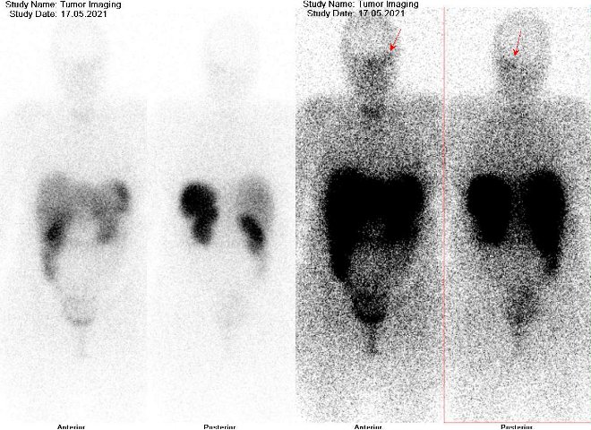 Obr. . 2: Celotlov scintigrafie v pedn a zadn projekci  dvoj modulace obrazu. Vyeten 24 hod. po aplikaci radioindiktoru. ipkou oznaeno loisko v lebce vlevo.