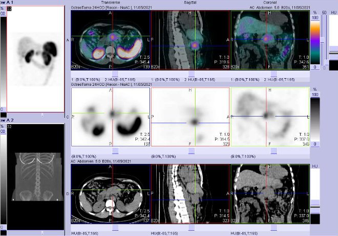Obr. . 4: Fze obraz SPECT a CT  vyeten 24 hod. po aplikaci radiofarmaka. Zameno na loisko v pankreatu.