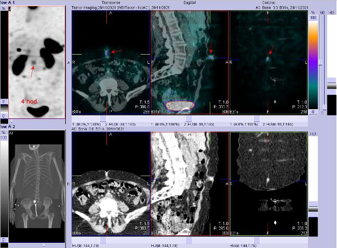 Obr. . 10: Fze obraz SPECT a CT. Zameno na loisko v podko. Vyeten 4 hod. po aplikaci OctreoScanu.