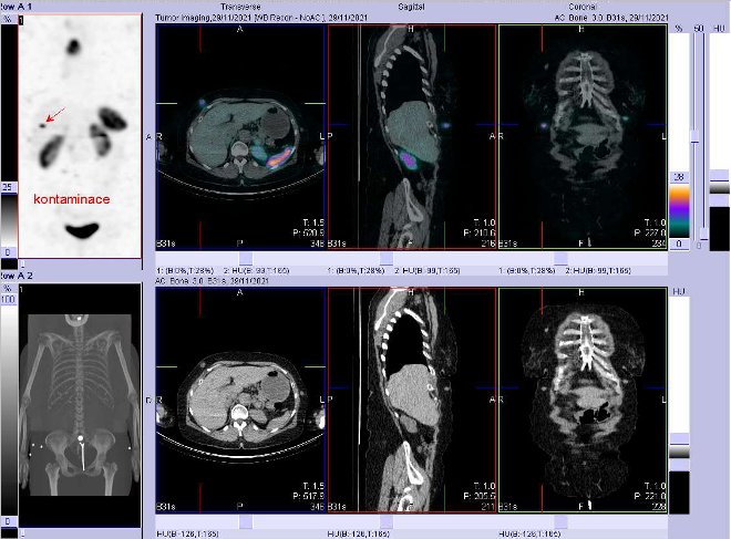 Obr. . 3: Fze obraz SPECT a CT. Zameno na loisko v podko. Vyeten 4 hod. po aplikaci OctreoScanu.